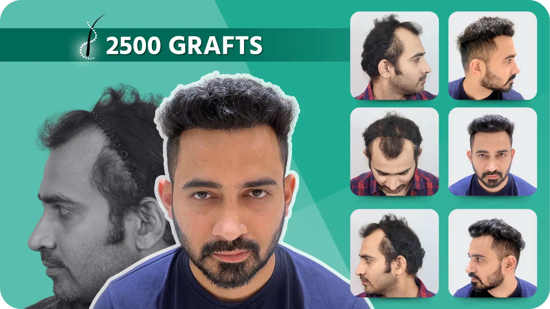 Hair Transplant and Cosmetic Center 37 Hair-Transplant-Results-1