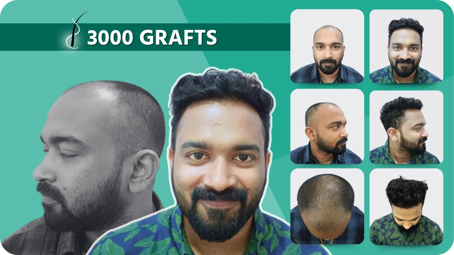 Hair Transplant and Cosmetic Center 32 Hair-Transplant-Results-2