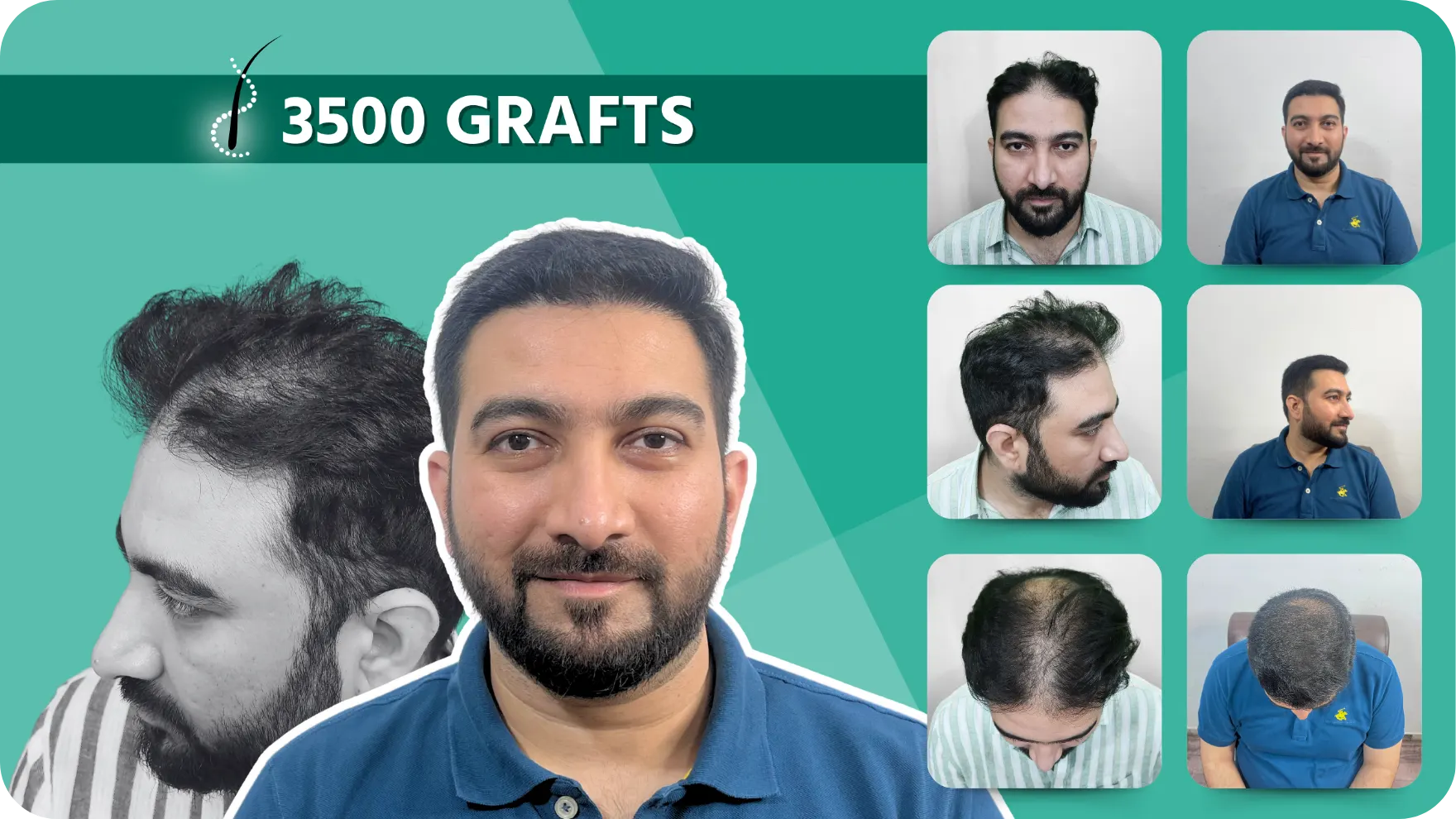 Hair Transplant and Cosmetic Center 35 Hair-Transplant-Results-3