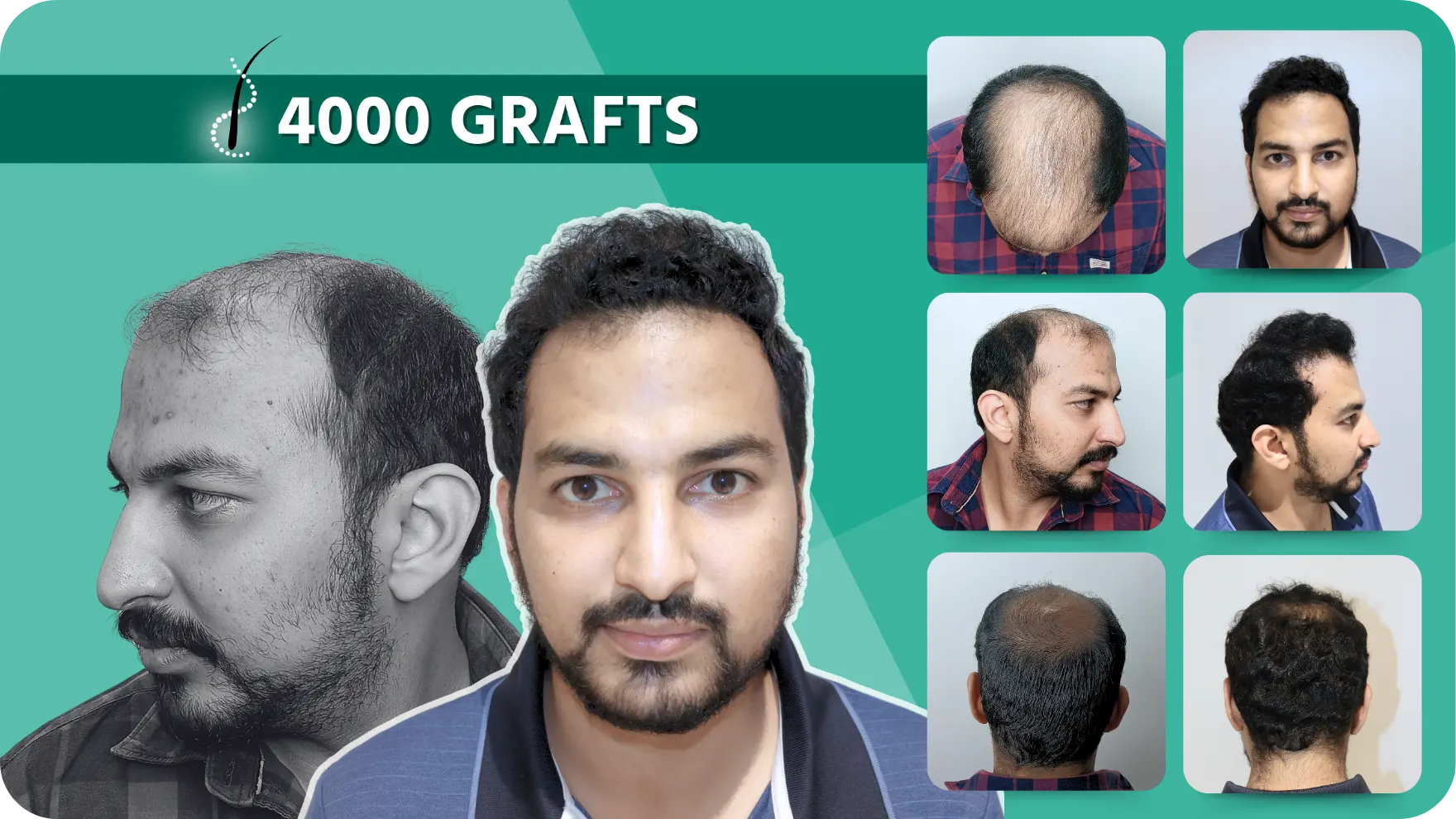 Hair Transplant and Cosmetic Center 33 Hair-Transplant-Results-4