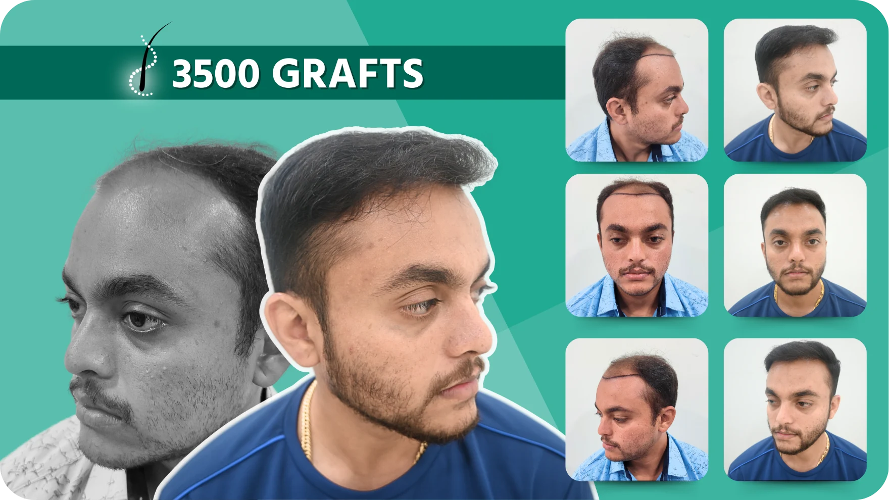 Hair Transplant and Cosmetic Center 31 Hair-Transplant-Results-7