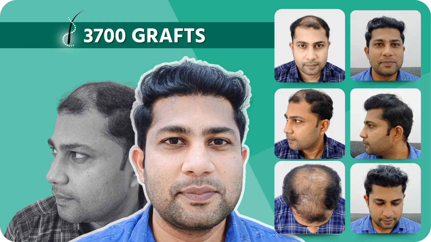 Hair Transplant and Cosmetic Center 36 Hair-Transplant-Results-8