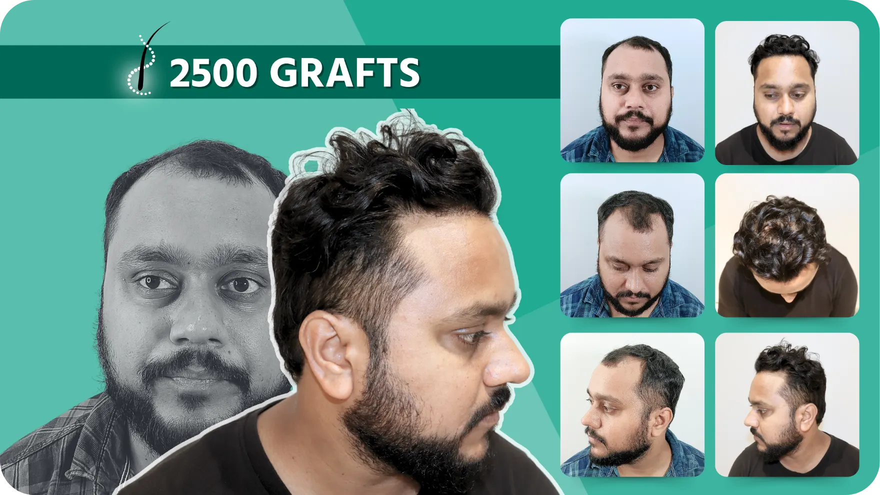 Hair Transplant and Cosmetic Center 34 Hair-Transplant-Results-9